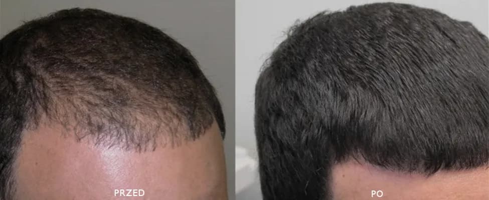 Skuteczne metody w medycynie chińskiej na wypadanie włosów