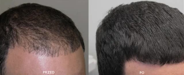 Skuteczne metody w medycynie chińskiej na wypadanie włosów