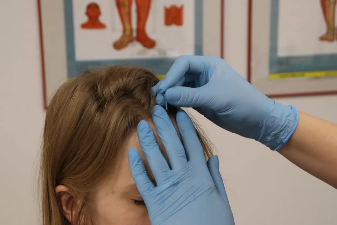 Akupunktura Tychy - znajdź najlepsze terapie i ceny w mieście