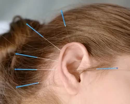 Akupunktura na szumy uszne opinie: Czy to skuteczna metoda leczenia?