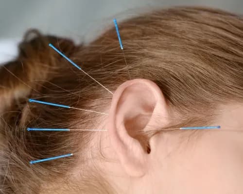 Akupunktura na szumy uszne opinie: Czy to skuteczna metoda leczenia?