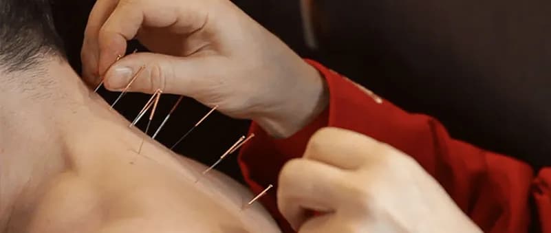 Złe samopoczucie po akupunkturze: co może być przyczyną i jak sobie pomóc